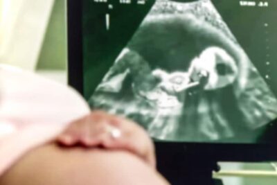 Amniocentesi: Quando si Fa, Procedure e Cosa Aspettarsi